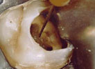 endodoncia