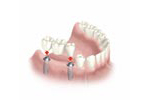 implantes