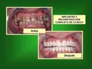 implantes